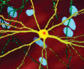 Image: A microscope image of a neuron with inclusion, stained orange, caused by Huntington's disease (Photo courtesy of Dr. Steven Finkbeiner).